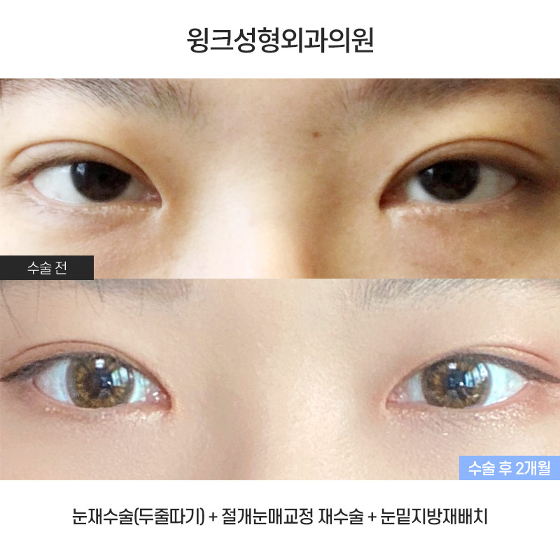 눈매교정의 효과에 대해 알아보겠습니다. 관련 이미지 1