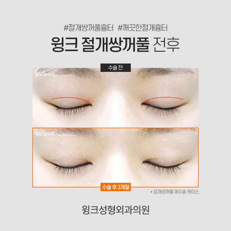 쌍꺼풀 깊은 고정 풀기 관련 이미지 4