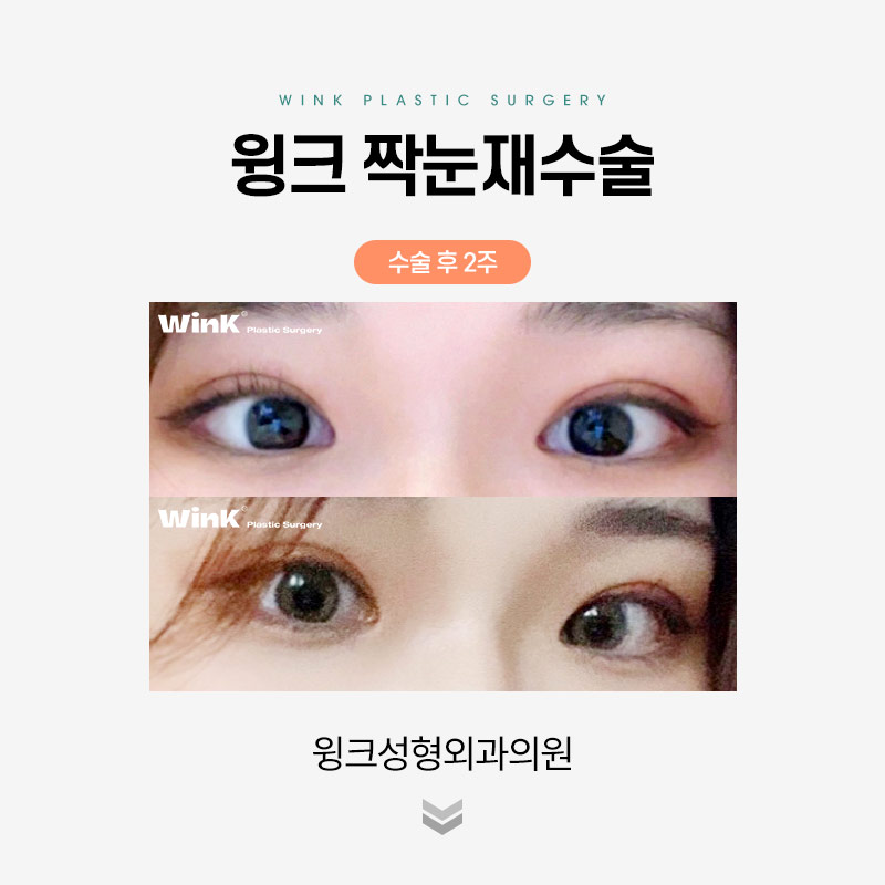 짝눈 쌍꺼풀 재수술에 관해 알아보겠습니다. 관련 이미지 4