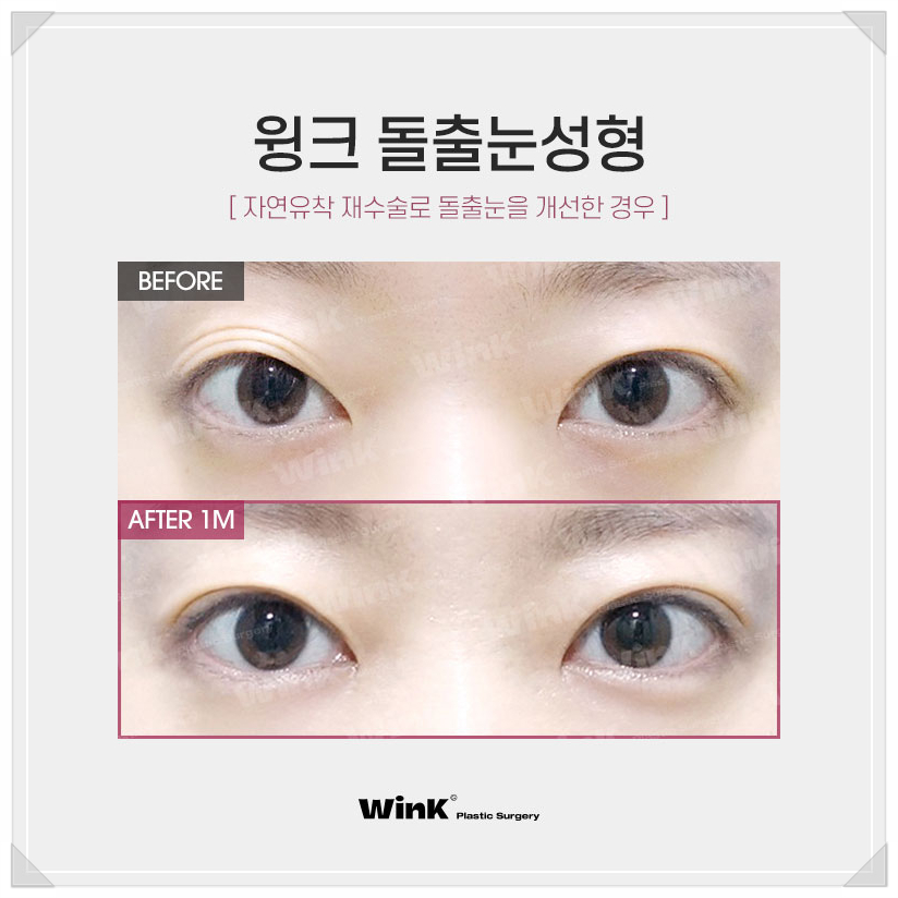 Post-Op Review of Protruding Eyes Surgery, Sunken Eye Fat Grafting, Wink Plastic Surgery Upper Eyelid Fat Repositioning Price, Protruding Eye Fat Grafting image 6