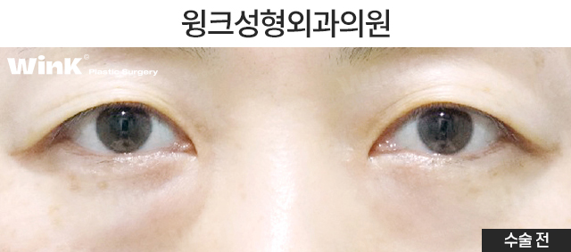 Lower Eyelid Fat Repositioning: Who Is It Effective For? image 5