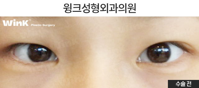 중학생 쌍커풀수술에 대해 알아볼까요? 관련 이미지 6