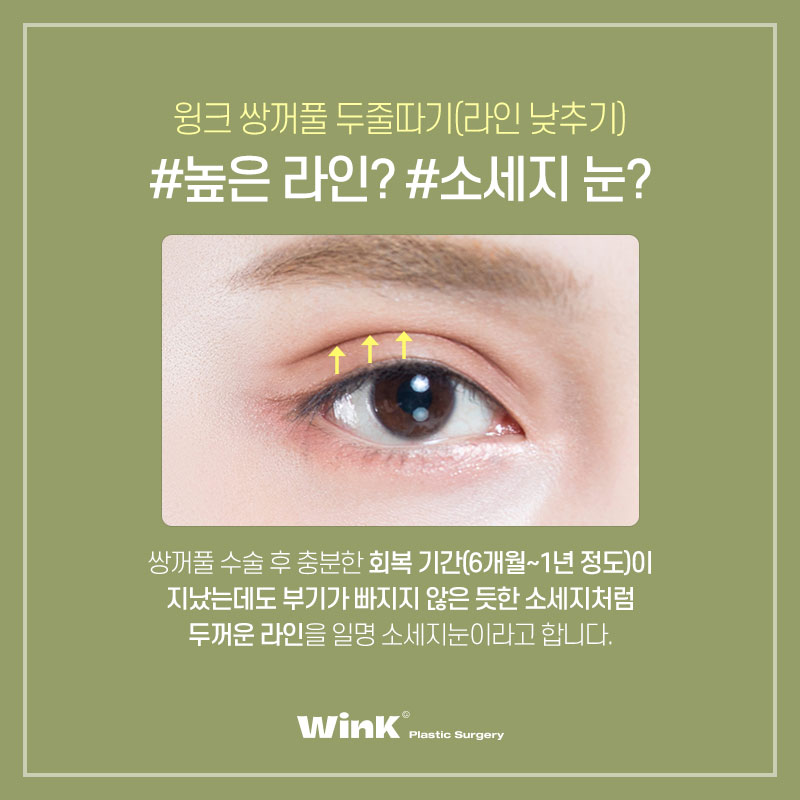 Are All Revision Eyelid Surgeries the Same? For High Crease "Sausage Eyes," Use Two-Line Technique to Lower the Front Line image 2