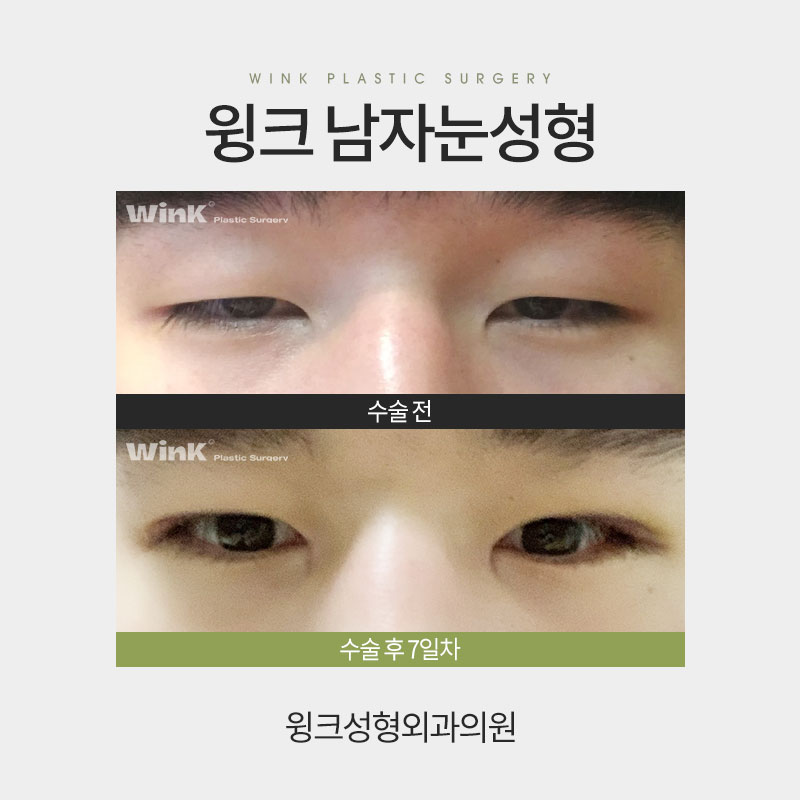 Male Eye Surgery: How Is It Best Done? image 5