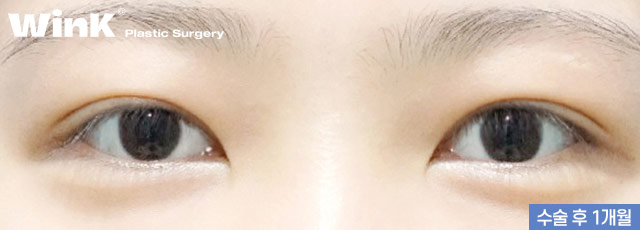 다 같은 라인? 윙크성형외과 심플커브 자연유착은 나에게 꼭 맞는 라인으로! 관련 이미지 9