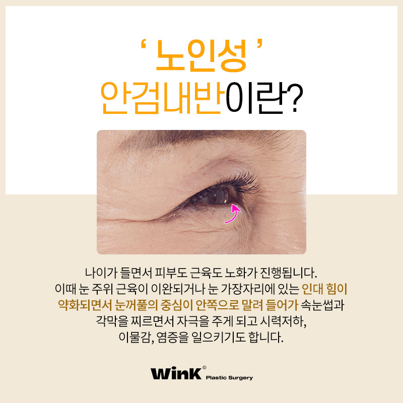 If the lower eyelashes are poking your eyes? Solve it with lower blepharoplasty for entropion at Wink Plastic Surgery image 2