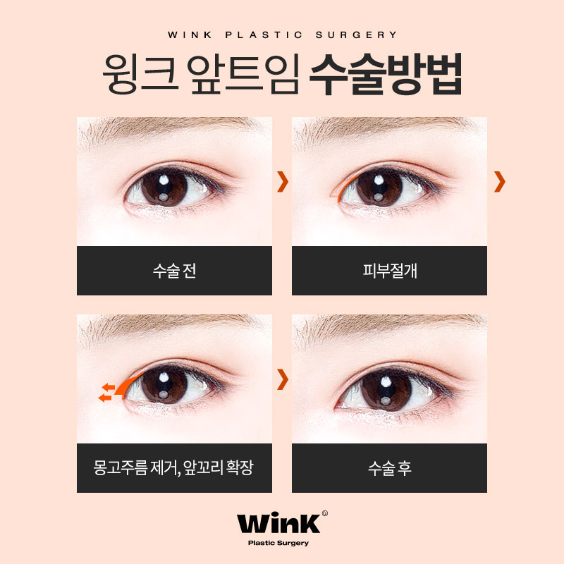 트임맛집 알아보고 있다면 윙크성형외과 신사앞트임비용 관련 이미지 4