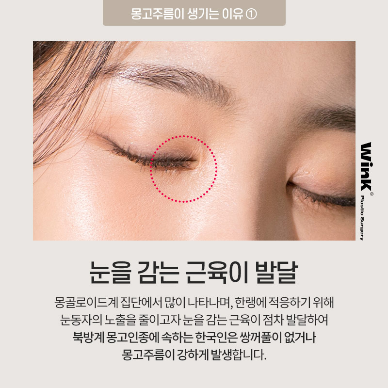 몽고주름이 쌍꺼풀 수술에 미치는 영향! 윙크성형외과에서 알려드려요 관련 이미지 3