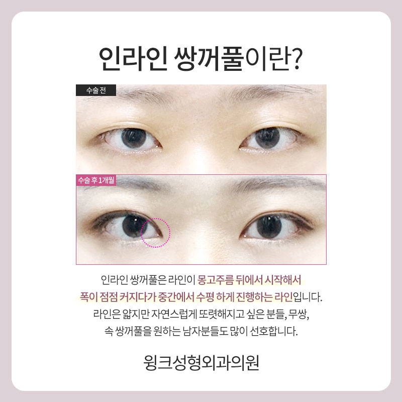 A Natural Line That Looks Just Like Your Original Eyes: In-line Double Eyelids image 2