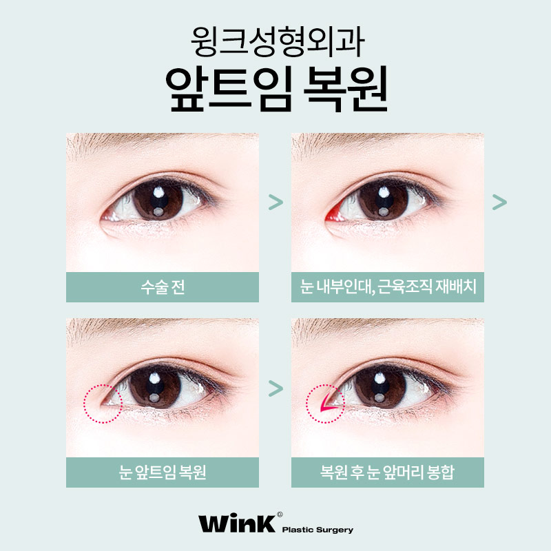 신사역앞트임복원 윙크성형외과  앞트임복원후기 알아보자! 관련 이미지 3