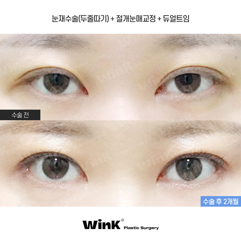 소세지눈? 윙크성형외과 두줄따기가 정답! 관련 이미지 1