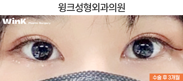 Is It Okay to Have Double Eyelid Surgery on Only One Side? image 5