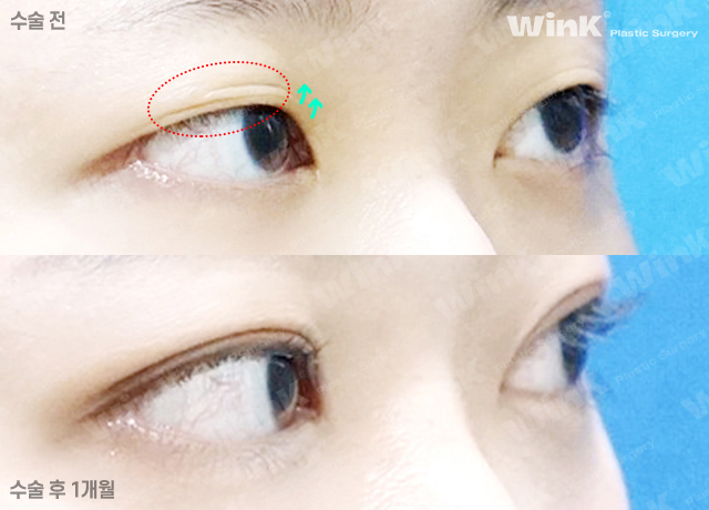 Simple Curve Natural Adhesion, Recommended for Those Who Find Incisional Surgery Burdensome Because It Offers Fast Recovery and a Natural Line! image 4