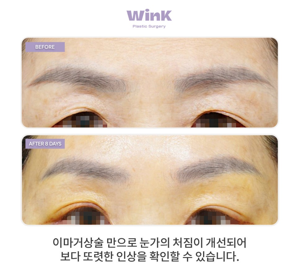 Forehead Lift (Forehead Lifting) — Why It Should Be Considered Along with Eye Surgery image 1