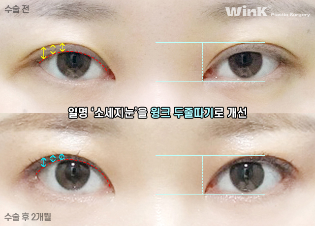 소세지눈? 윙크성형외과 두줄따기가 정답! 관련 이미지 13
