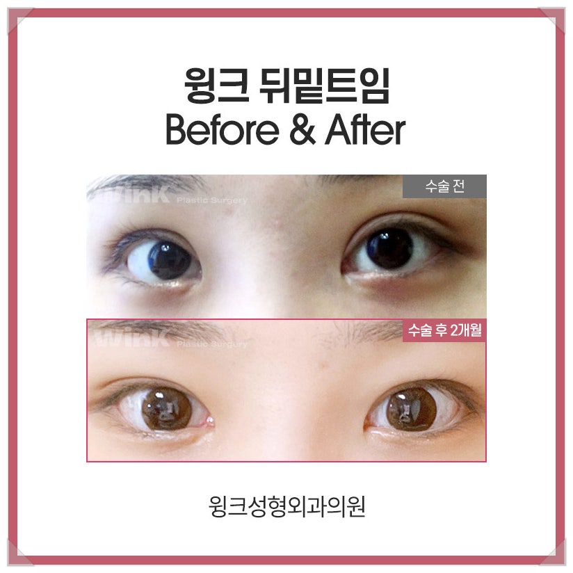If You’re Looking Into Reviews of Dual Canthoplasty That Softens a Fierce Look image 5