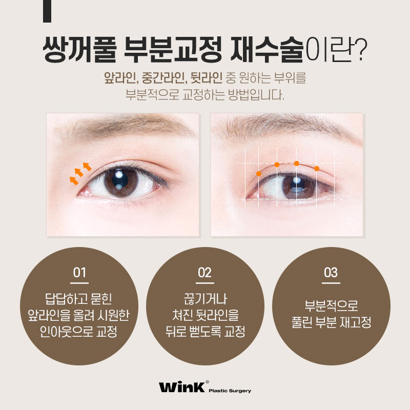 쌍꺼풀이 앞라인만 마음에 들지 않다면 윙크성형외과 쌍꺼풀 부분교정! 관련 이미지 3