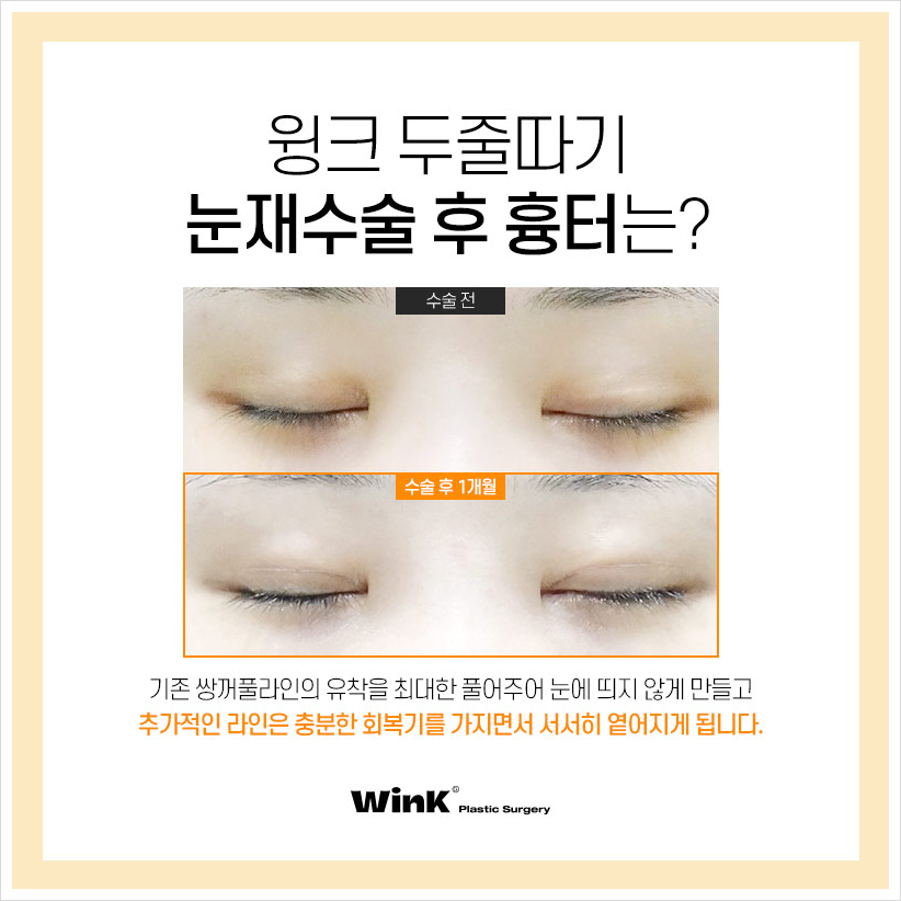 Sausage Eyes After Double Eyelid Surgery: If You’re Concerned About a Bulky Double Eyelid, Wink Plastic Surgery’s Double Eyelid Line Lowering and Sausage Eye Revision Surgery Costs image 6