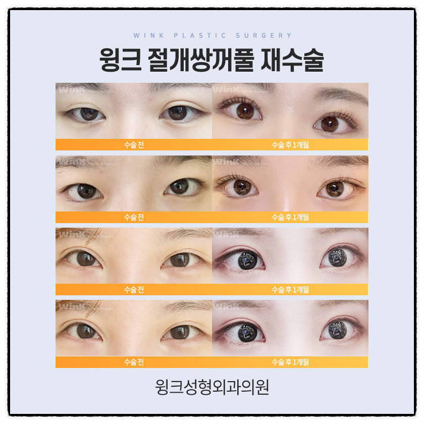 쌍꺼풀절개재수술 절개쌍수재수술후기로 흉터부터 회복까지 알아보자! 관련 이미지 7