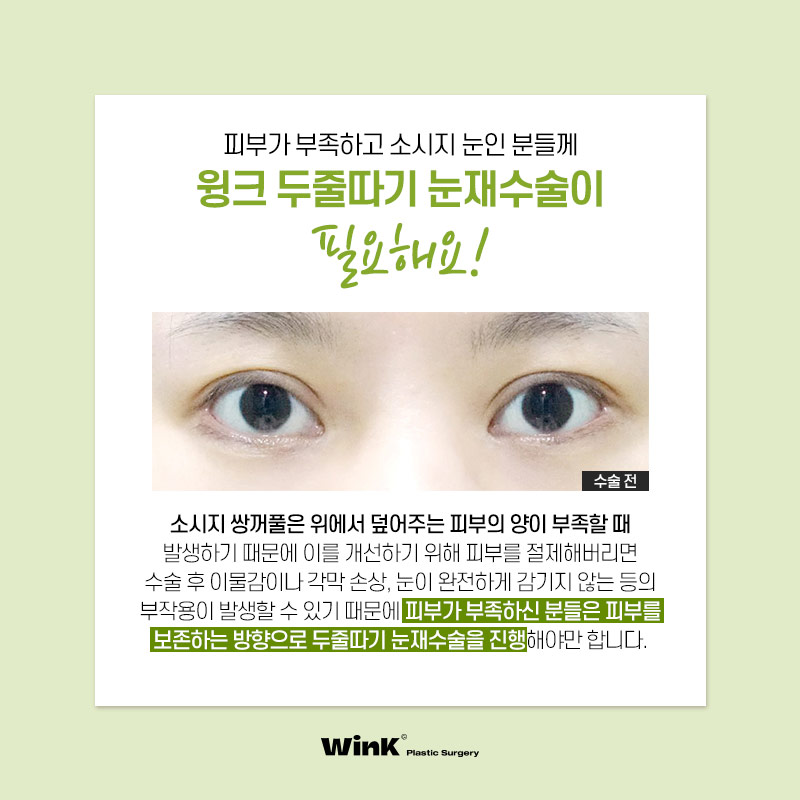 Thick Double Eyelids, “Sausage Eyes.” Let’s Improve Them Naturally with Wink’s Double-Incision Double Eyelid Revision Surgery! image 7