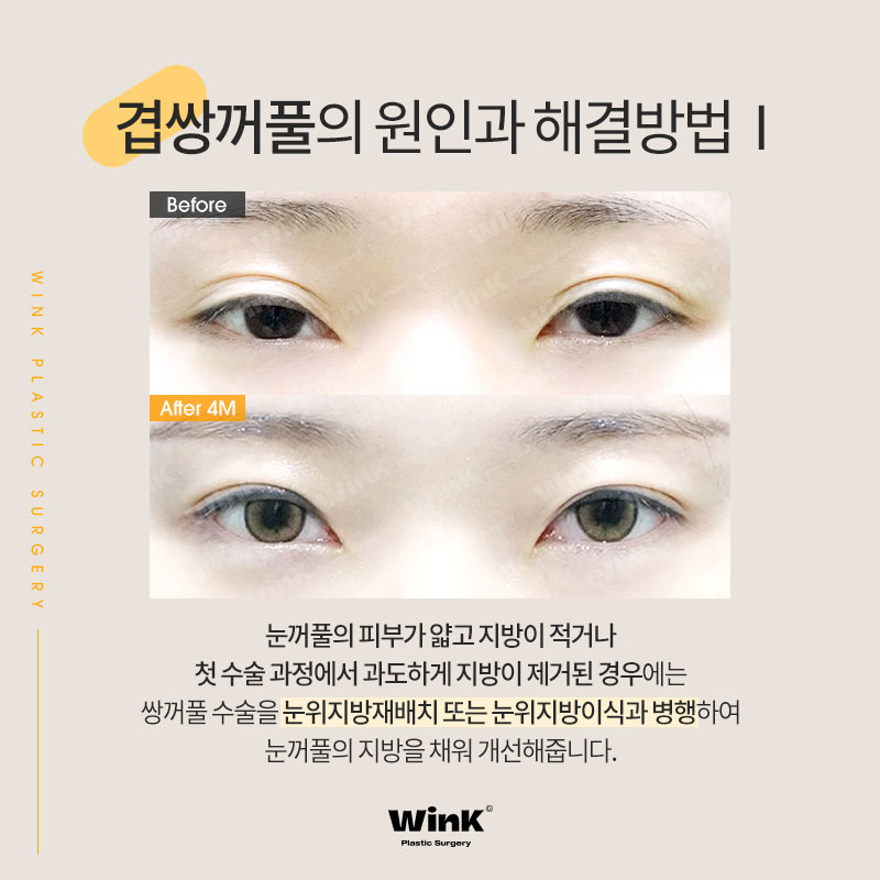 윙크성형외과에서 알려드리는 겹쌍꺼풀과 눈 뜨는 힘이 중요한 이유! 관련 이미지 4