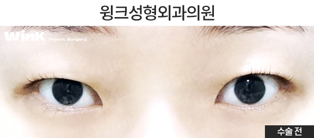 Let’s Take a Look at the Changes and Effects Before and After Upper Epicanthoplasty image 2