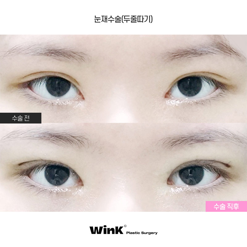 두줄따기 눈재수술로 수술 직후에도 자연스럽게! 관련 이미지 1