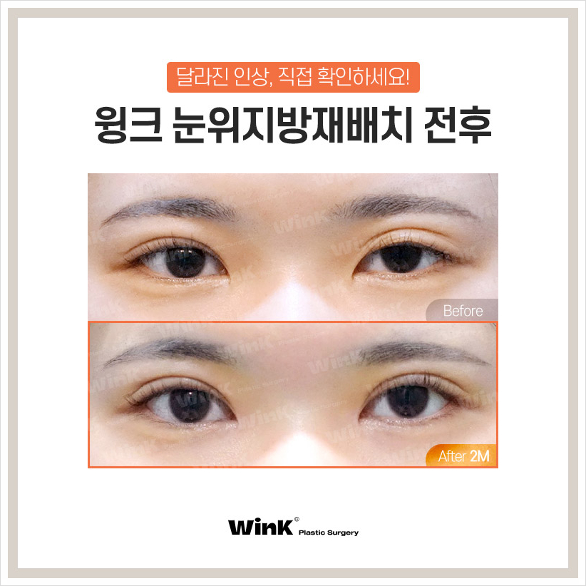 Wink Plastic Surgery Upper Eyelid Fat Repositioning Sleepy Eye Surgery Sinsa Sunken Eye Fat Grafting image 6