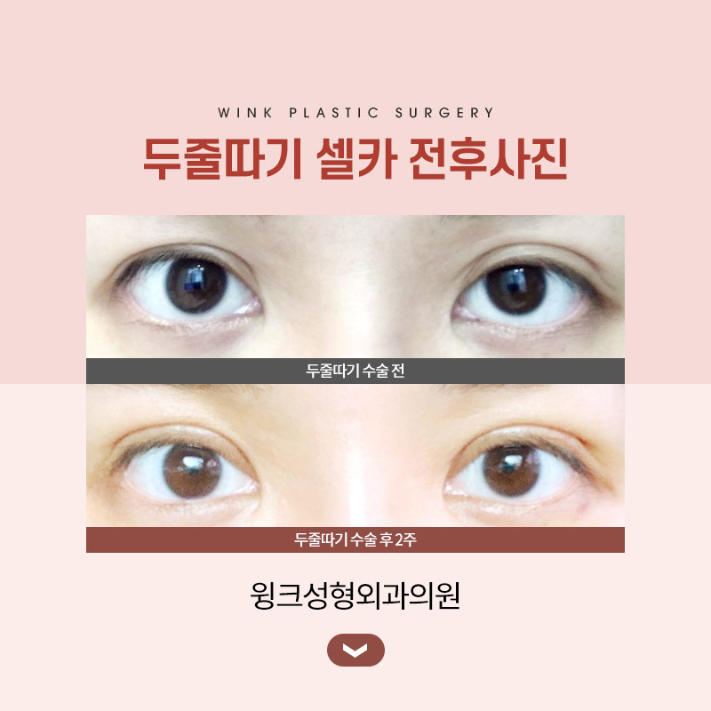 A sausage line can be improved with double-line blepharoplasty revision surgery. image 6