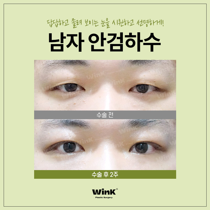 Male Ptosis? Improved Naturally and Unnoticeably at Wink Plastic Surgery! image 4