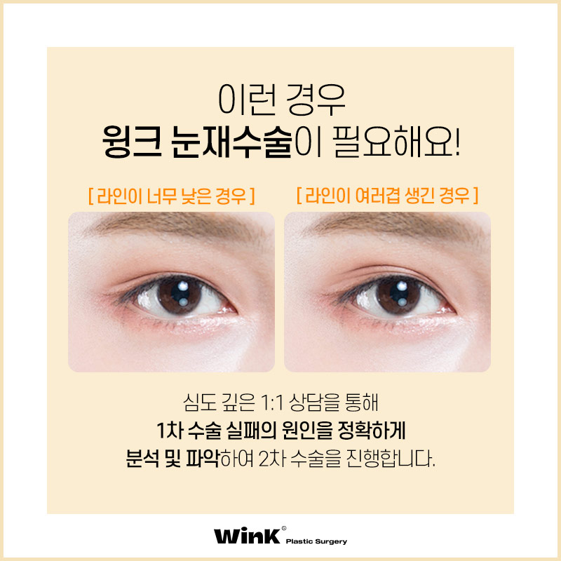 윙크성형외과에서 알려드리는 적절한 눈재수술 시기 관련 이미지 2