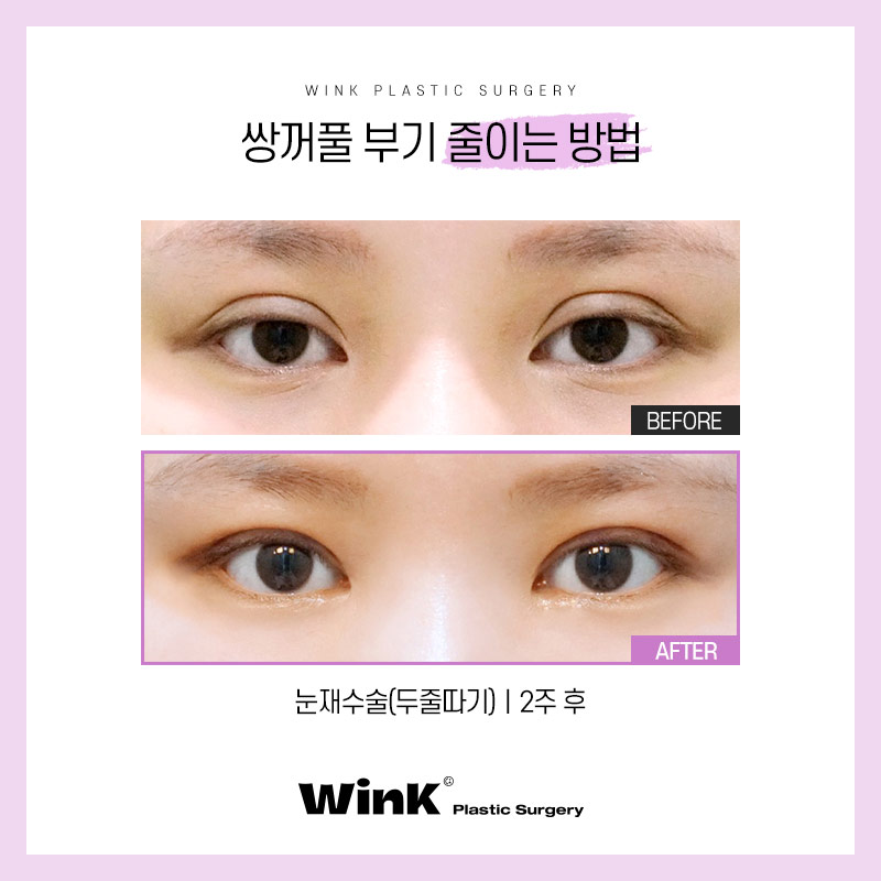 How to Reduce Swelling After Double Eyelid Surgery: Wink Plastic Surgery Explains! image 4