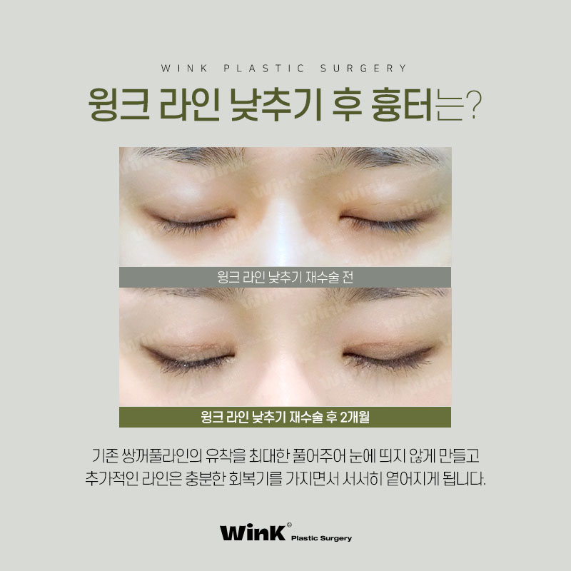 부담스러운 소세지눈? 윙크성형외과 두줄따기 쌍꺼풀 라인낮추기로 호감형 이미지로! 관련 이미지 6