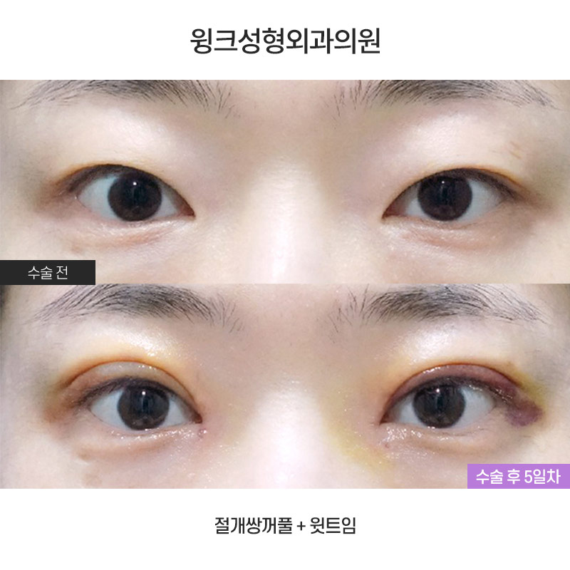윗트임은 어떤 경우에 하면 좋을까요? 관련 이미지 1