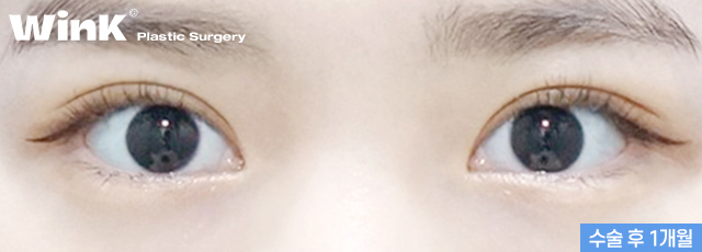 Can I Have My Eyes Surgery Done with Natural Adhesion Too? image 6
