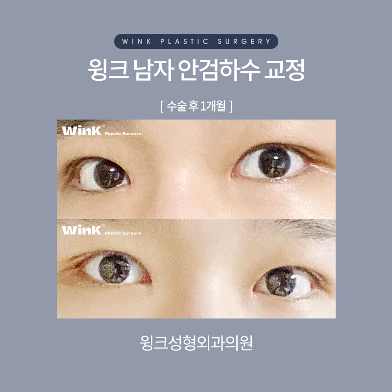 남자안검하수 또렷하게 교정하여 시원한 인상으로 개선하는 방법 관련 이미지 6