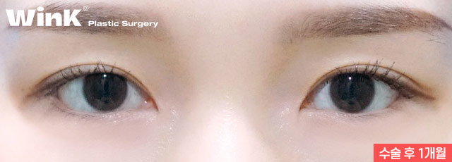 Wink canthoplasty and lower canthoplasty to overcome a cramped-looking eye shape! image 7