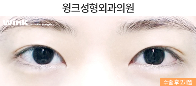 인라인 자연유착 쌍꺼풀 수술에 대해 알아볼까요? 관련 이미지 6