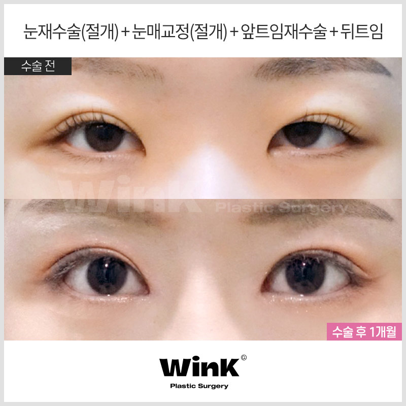 신사눈재수술후기 신사눈재수술전후 윙크성형외과 눈재수술 관련 이미지 3