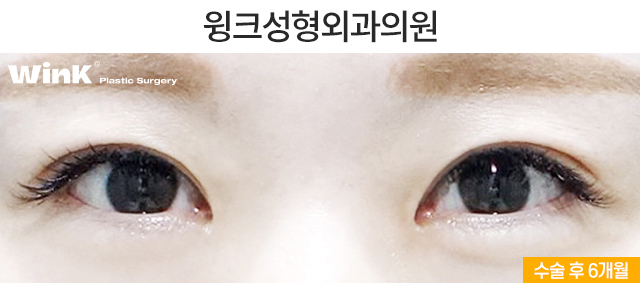 Turning a Thick Outer-Line Double Eyelid into a Natural Inline Through Double-Fold Revision image 3