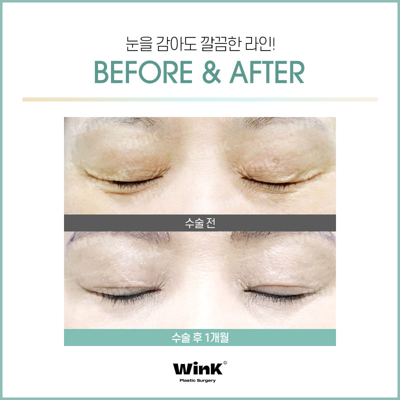 윙크성형외과에서 알려드리는 상안검에 대한 모든 것! 관련 이미지 3