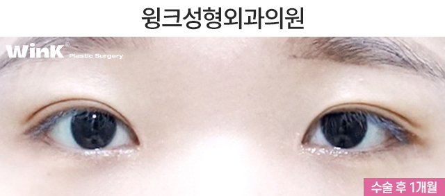 Should We Leave Eyelid Tape and Eyelid Glue Behind with Natural Adhesion Double Eyelid Surgery? image 3