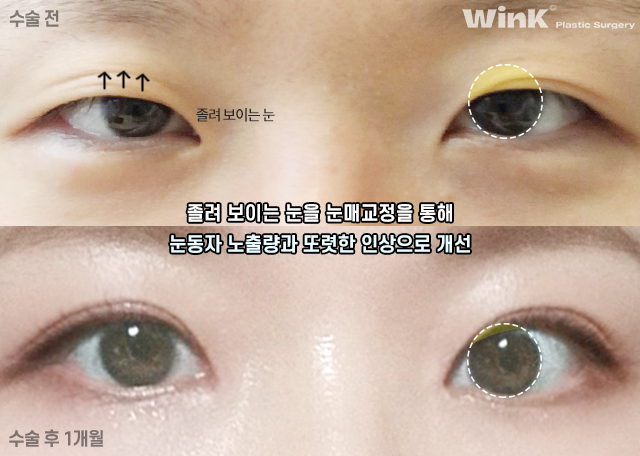 눈매교정의 효과에 대해 알아보겠습니다. 관련 이미지 7