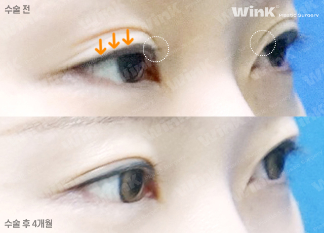 Lowering the Double Eyelid Line: Making Thick Double Eyelids (Sausage Eyes) Look Natural with a Two-Line Revision Surgery! image 4