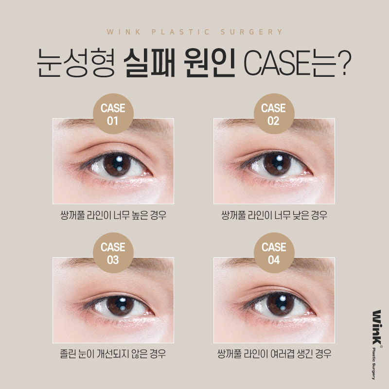눈을 떠도, 눈을 감아도 자연스러운 윙크성형외과 절개쌍꺼풀 재수술 관련 이미지 3