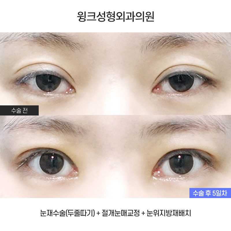 Let’s Learn About Double-Eyelid Revision Surgery with an Incision for a Thick Front Line image 1