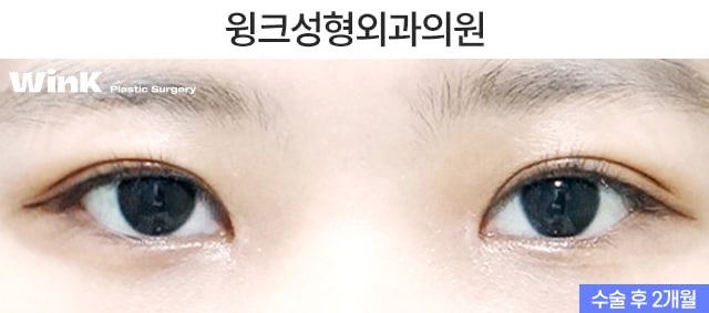 겹쌍꺼풀 해결 방법에 대해 알아보겠습니다. 관련 이미지 6