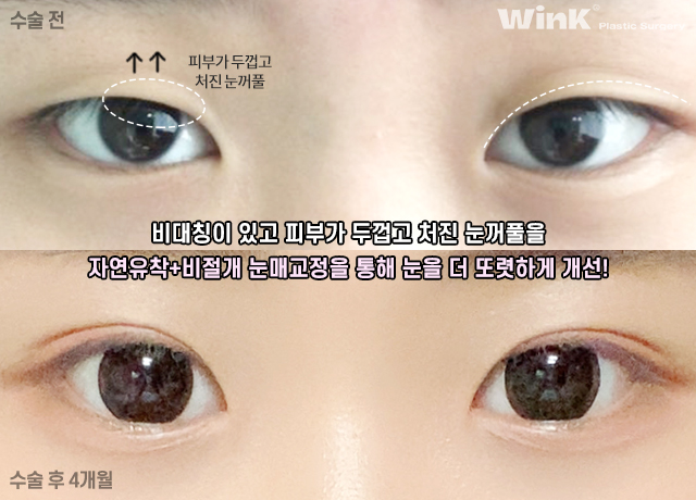 중학생 쌍커풀수술에 대해 알아볼까요? 관련 이미지 5