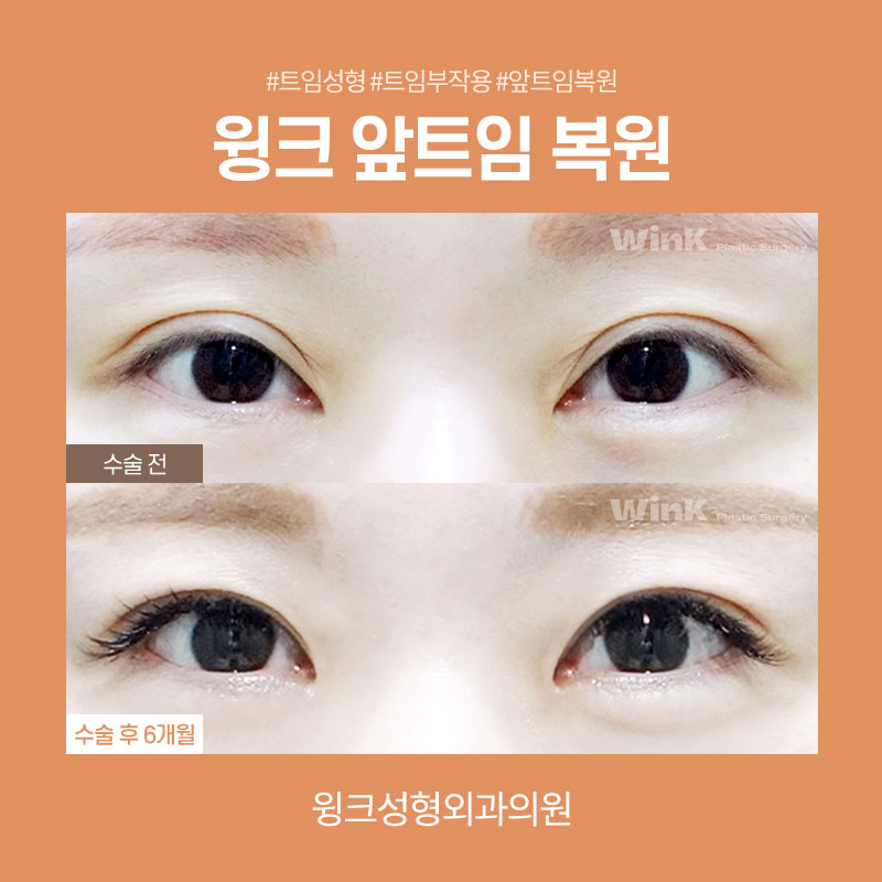 Let’s Learn About Epicanthoplasty Revision image 4
