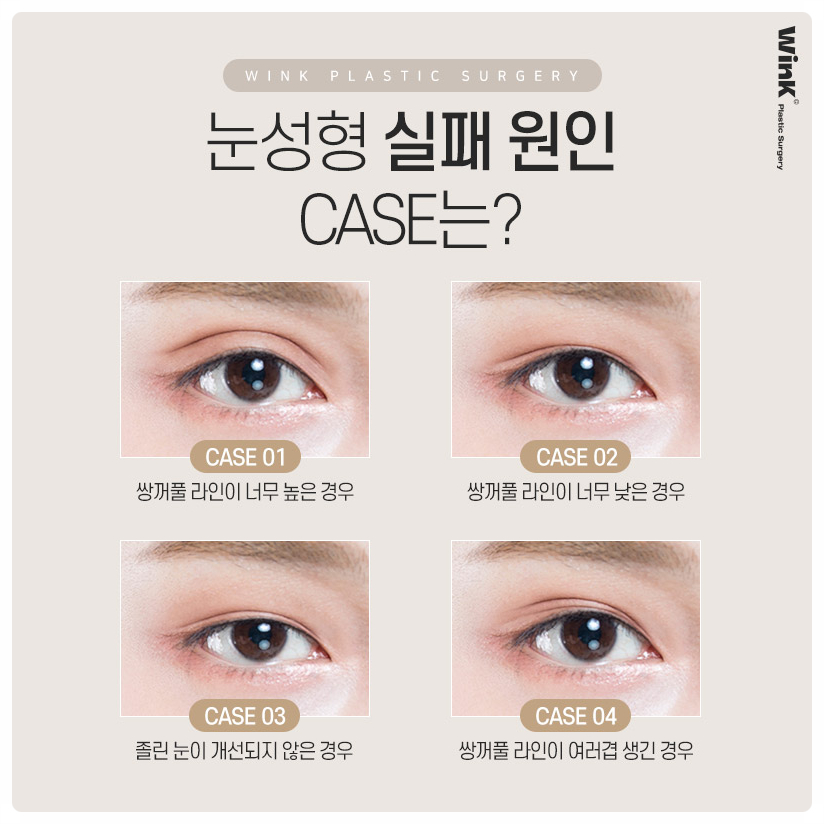 쌍꺼풀절개재수술 신사쌍꺼풀수술 쌍꺼풀수술잘하는곳? 윙크성형외과 관련 이미지 3
